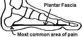 Inferior Calcaneal Spur